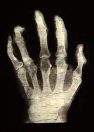 X-ray ng kamay
